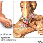 Ankle Sprain Type 3