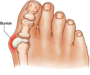 Podiatrist near you treating Bunions