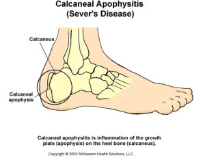 Podiatrist in your area treatsCalcaneal Apophysitis