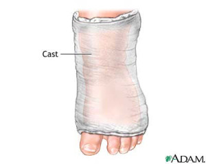 Podaitrist Treatment of Clubfoot Cast