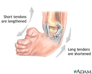 Podaitrist Treatment of Clubfoot Tendons