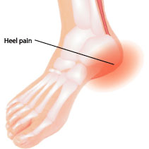Heel pain
