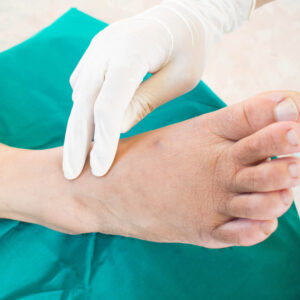 Charcot Foot