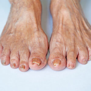 Toenail Abnormalities